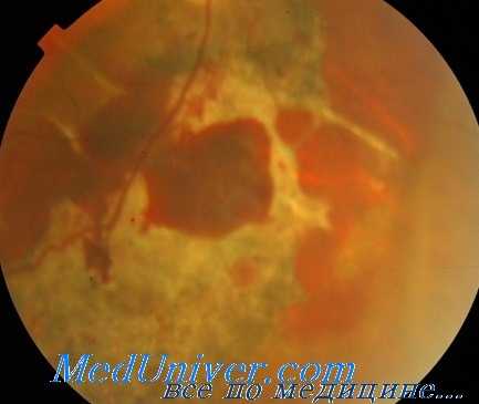 контузия сетчатки