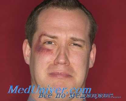 контузия хрусталика