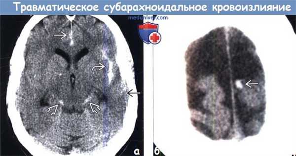 Субарахноидальное кровоизлияние после травмы на КТ