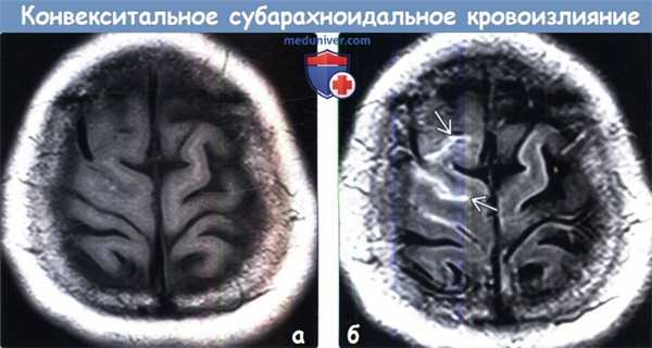 Конвекситальное субарахноидальное кровоизлияние (кСАК) на МРТ