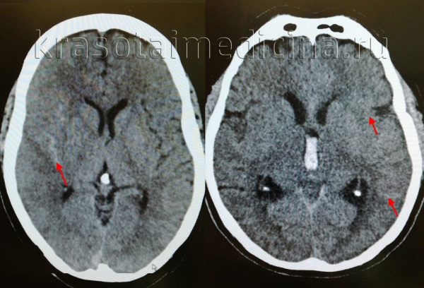 Субарахноидальное кровоизлияние