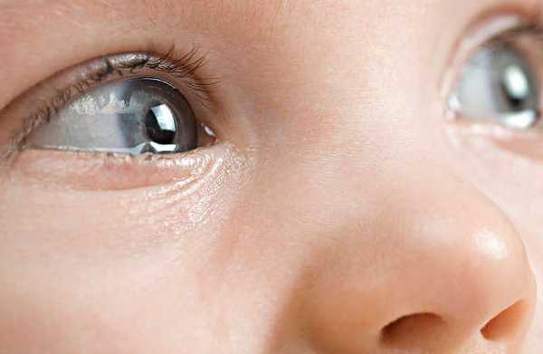 Конъюнктивит глаз у детей