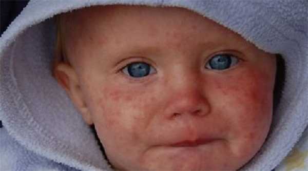 Корь у детей