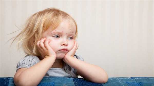 Симптомы кори у детей