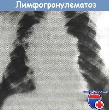 Лимфогранулематоз