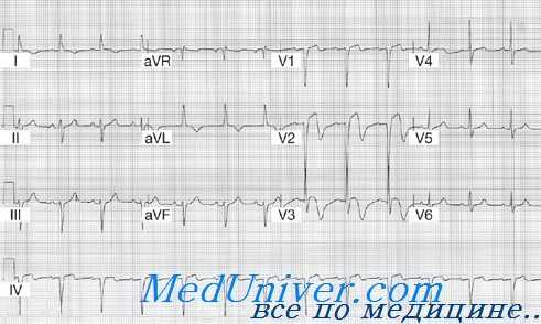 ЭКГ при кардиомиопатии Такоцубо