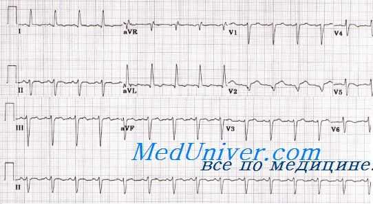 ЭКГ при кардиомиопатии Такоцубо