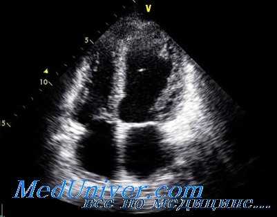 стрессовая кардиомиопатия