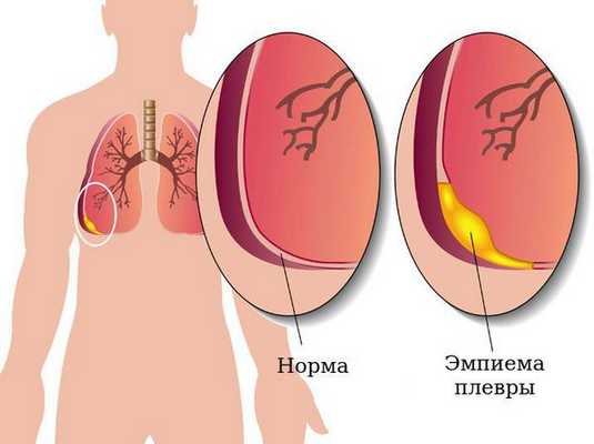 Эмпиема плевры