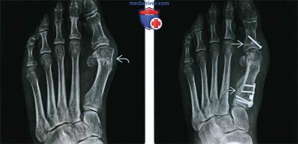 Коррекция hallux valgus - лучевая оценка