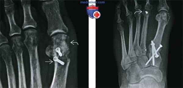 Коррекция hallux valgus - лучевая оценка