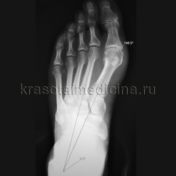 Hallux valgus