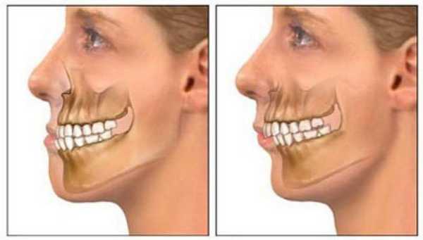 исправление прикуса коронками