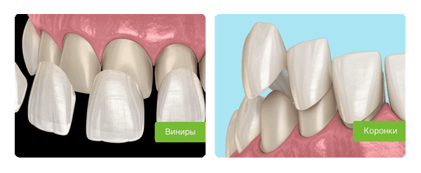коронки и виниры