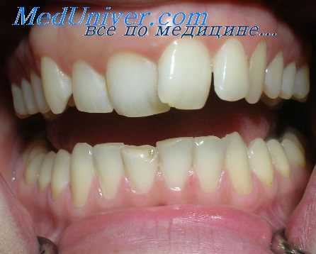 коррозия зубных протезов