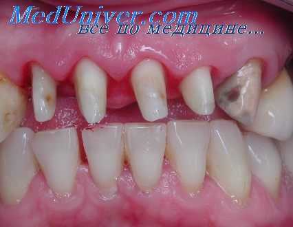 коррозия зубных протезов