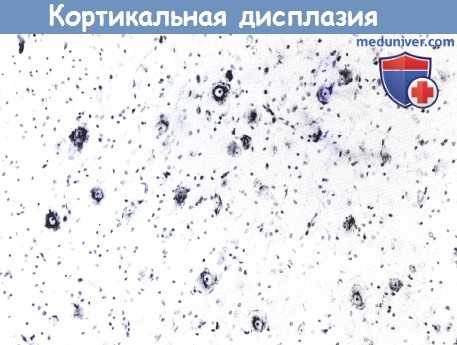 Кортикальная дисплазия