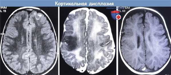 Кортикальная дисплазия