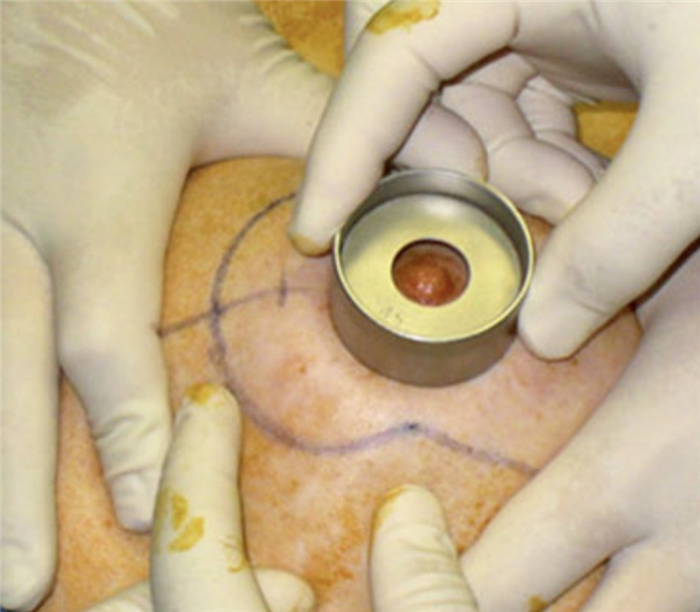 мастопексия