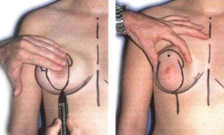 Вертикальная подтяжка