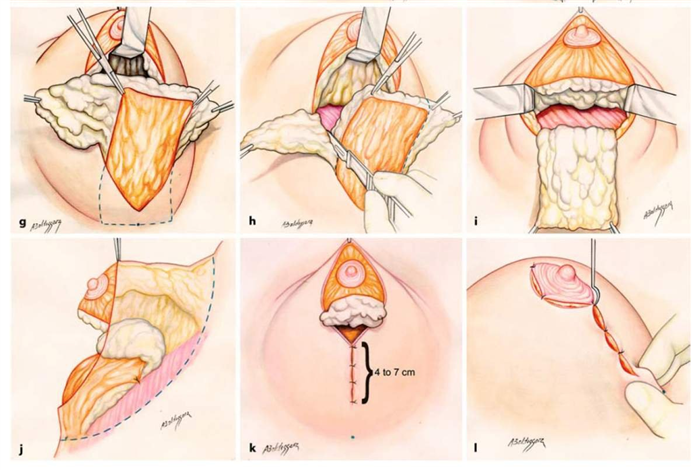 вертикальная подтяжка