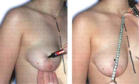 вертикальная подтяжка