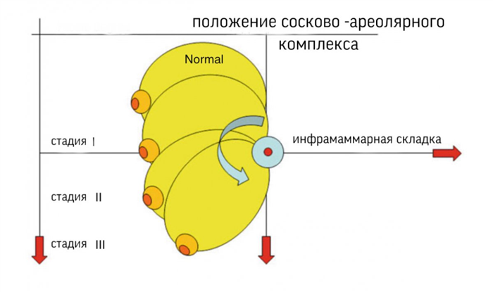 вертикальная подтяжка