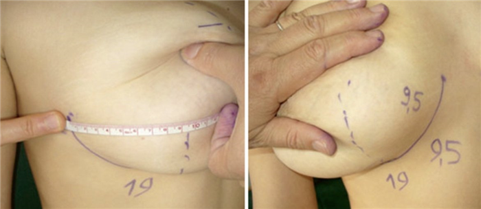 мастопексия