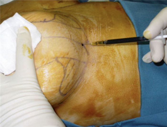 мастопексия