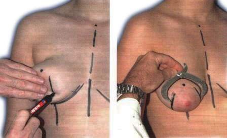 вертикальная подтяжка