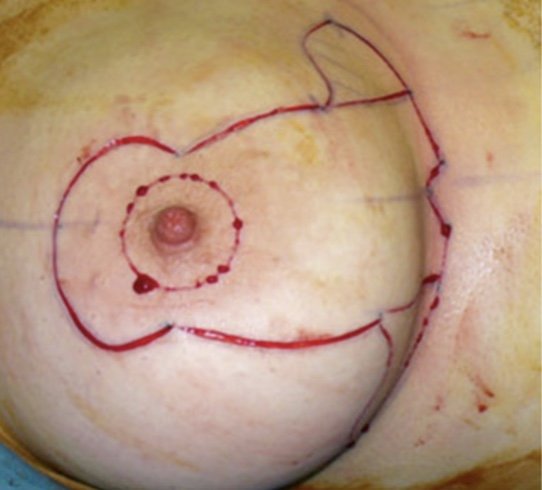 мастопексия