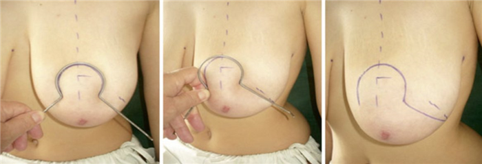 мастопексия