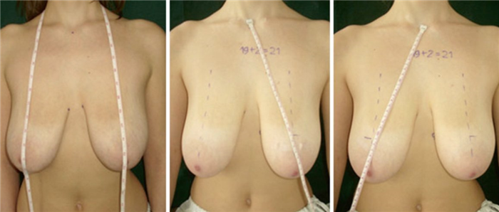 мастопексия