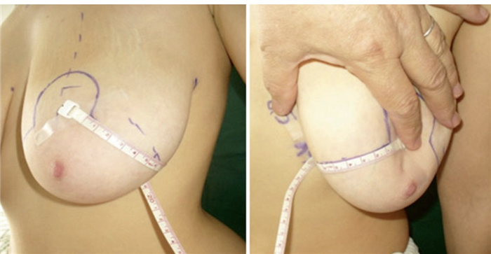 мастопексия