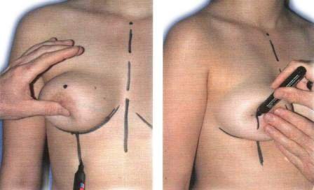 вертикальная подтяжка