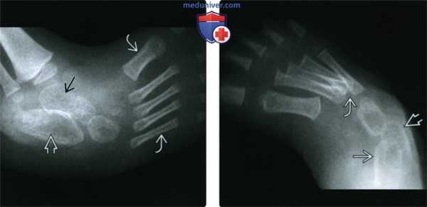 Рентгенограмма, КТ, МРТ, УЗИ при косолапости (эквиварусной деформации стопы)