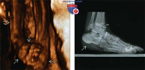 Рентгенограмма, КТ, МРТ, УЗИ при косолапости (эквиварусной деформации стопы)