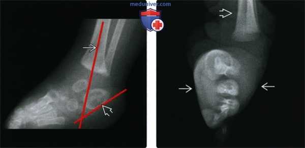 Рентгенограмма, КТ, МРТ, УЗИ при косолапости (эквиварусной деформации стопы)