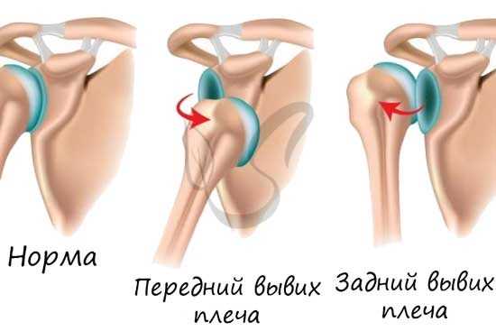 Вывих сустава