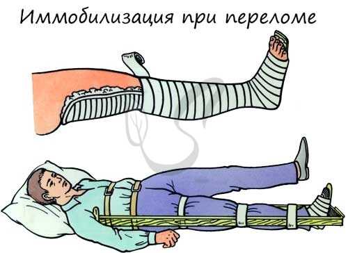 Иммобилизация при переломах