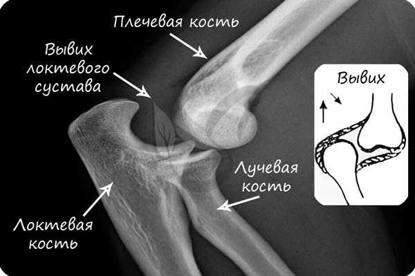 Вывих локтевого сустава