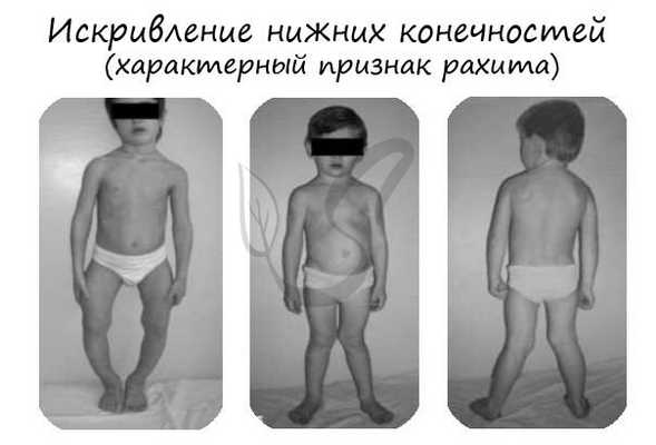 Рахит, искривление нижних конечностей