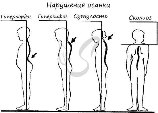 Нарушения осанки