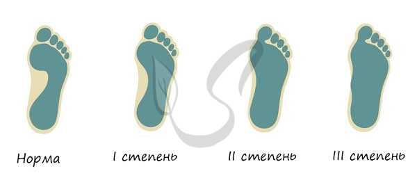 Плоскостопие