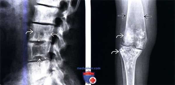 Рентгенограмма, МРТ при болезни Гоше