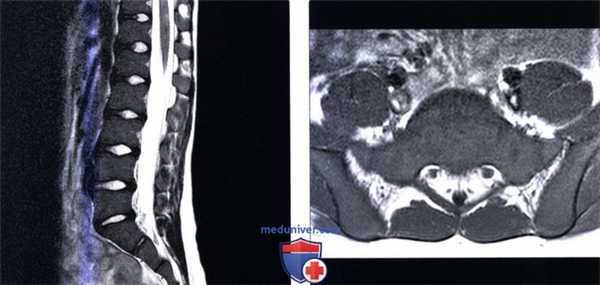 Рентгенограмма, МРТ при болезни Гоше