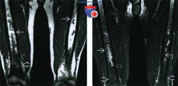Кости при болезни Эрдгейма-Честера - лучевая диагностика