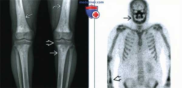 Кости при болезни Эрдгейма-Честера - лучевая диагностика