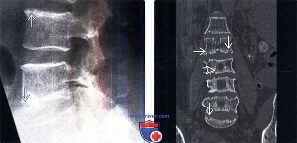 Рентгенограмма, КТ позвоночника при гиперпаратиреозе
