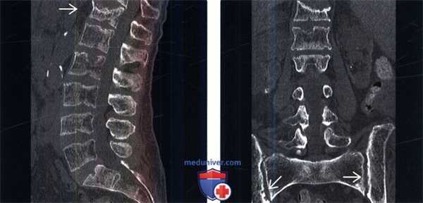Рентгенограмма, КТ позвоночника при гиперпаратиреозе